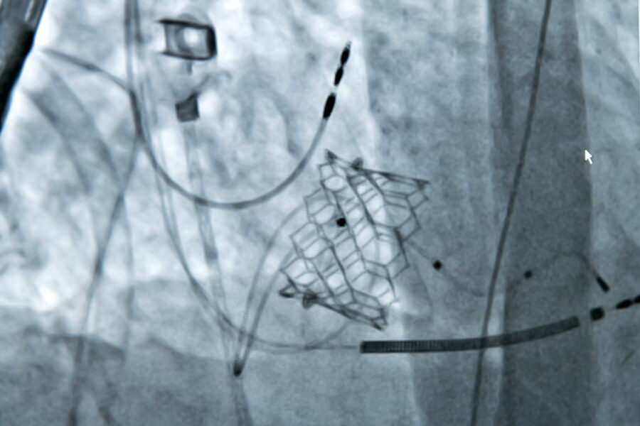 Die kathetergestützte Aortenklappen-implantation - Titelbild